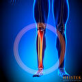Shin Splints