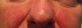 Rosacea