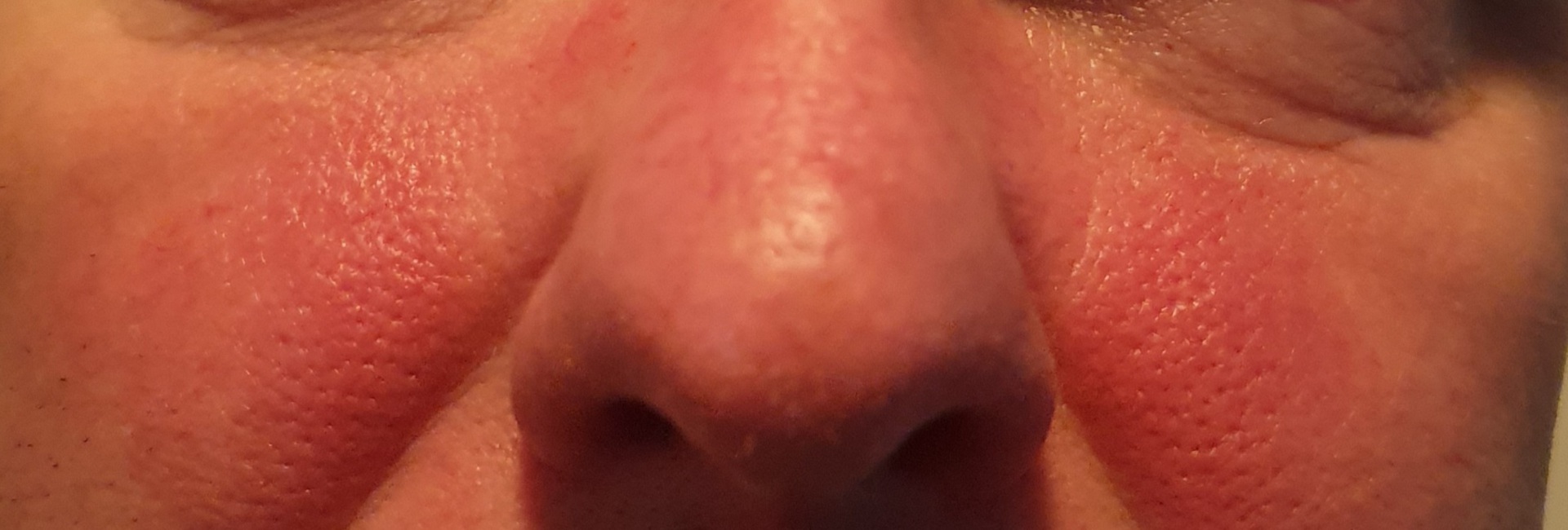 Rosacea