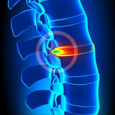Hernia