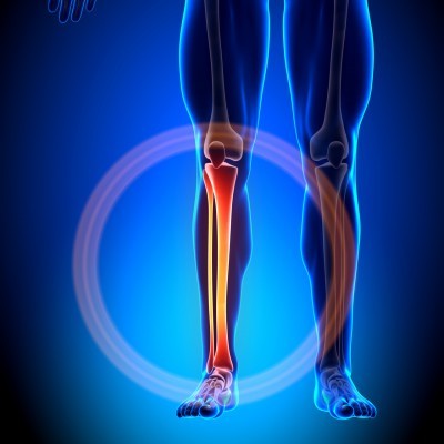 Shin Splints